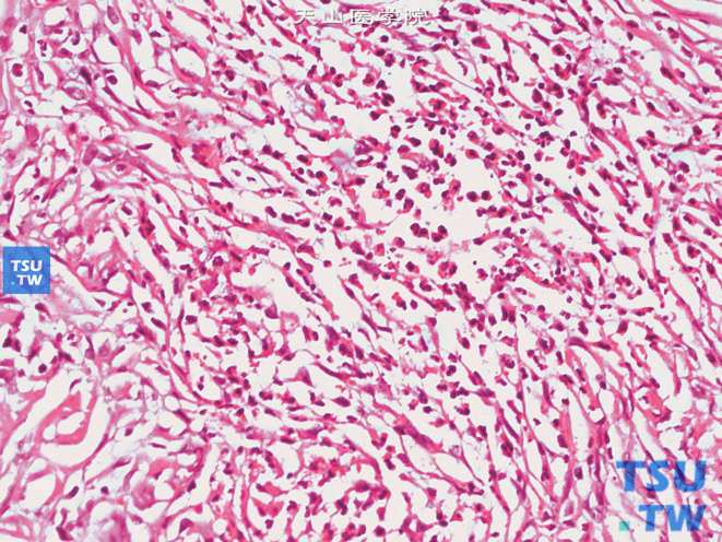 肾炎性假瘤，纤维组织间可见中性粒细胞及嗜酸性粒细胞