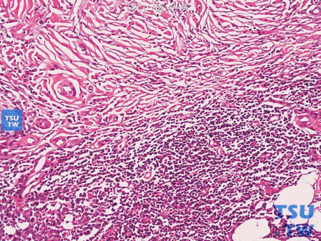 肾炎性假瘤，纤维组织间大量淋巴细胞