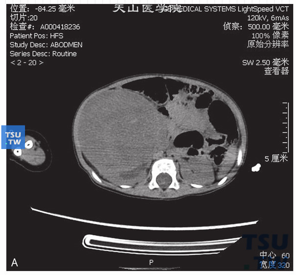 图A：CT，肾母细胞瘤，男，4岁，腹部包块；右肾见一实性软组织密度灶，边缘清晰，周围组织受压移位。增强后病灶逐渐强化，内部见无强化坏死灶