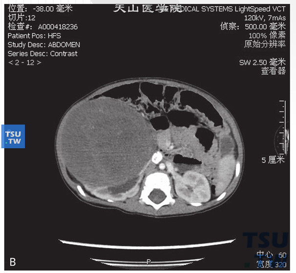 图B：CT，肾母细胞瘤，男，4岁，腹部包块；右肾见一实性软组织密度灶，边缘清晰，周围组织受压移位。增强后病灶逐渐强化，内部见无强化坏死灶