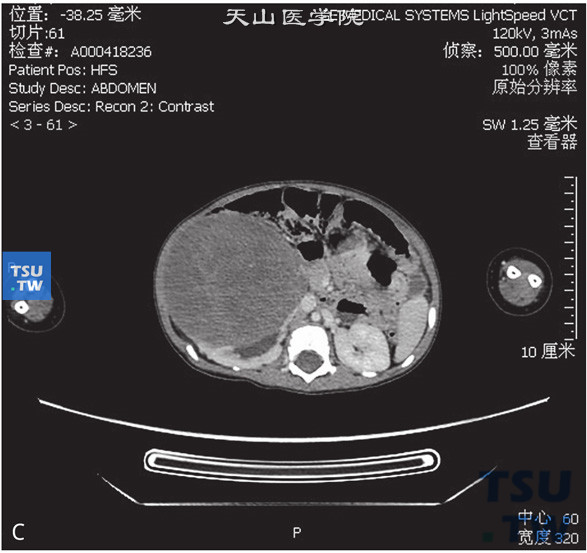 图C：CT，肾母细胞瘤，男，4岁，腹部包块；右肾见一实性软组织密度灶，边缘清晰，周围组织受压移位。增强后病灶逐渐强化，内部见无强化坏死灶