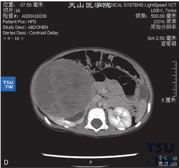 图AD：CT，肾母细胞瘤，男，4岁，腹部包块；右肾见一实性软组织密度灶，边缘清晰，周围组织受压移位。增强后病灶逐渐强化，内部见无强化坏死灶