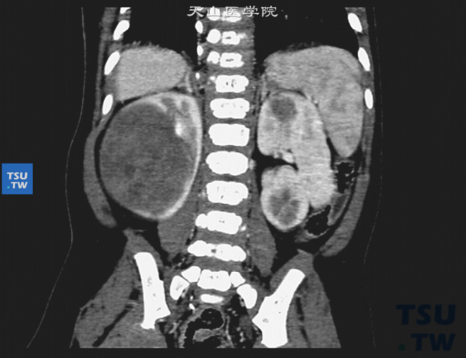 儿童肾母细胞瘤，CT增强示右肾实性质均肿物，左肾上、下极及右肾上极类圆形小的未强化区