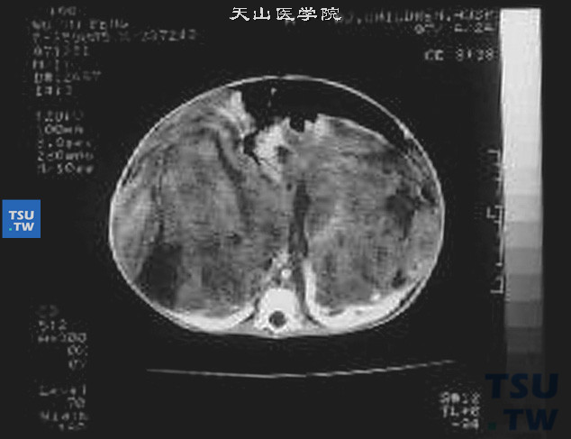 儿童肾母细胞瘤，CT显示双侧肾脏巨大肿物，残留肾实质极薄