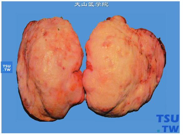 儿童胎儿横纹肌瘤型肾母细胞瘤，手术切除后标本，显示肾肿瘤切面像子宫肌瘤样，实性、质韧