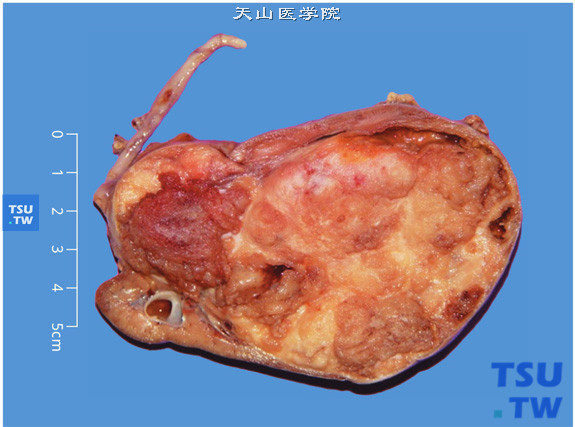 儿童肾母细胞瘤，切面显示肿物占据肾脏大部，呈多结节、鱼肉状，肿瘤压迫肾实质使局部皮质极薄