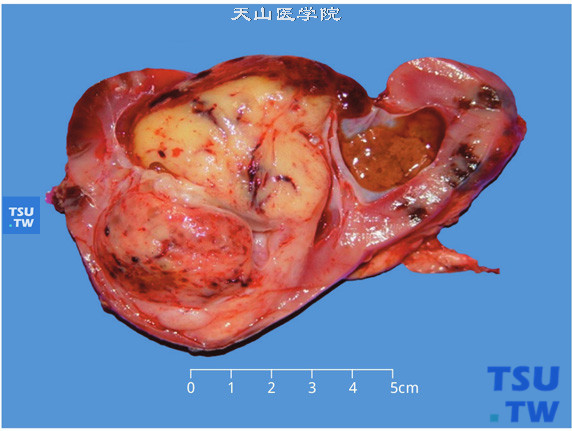 儿童肾母细胞瘤，切面显示肿物位于肾的一极，呈多结节、鱼肉状，压迫肾脏形成假包膜