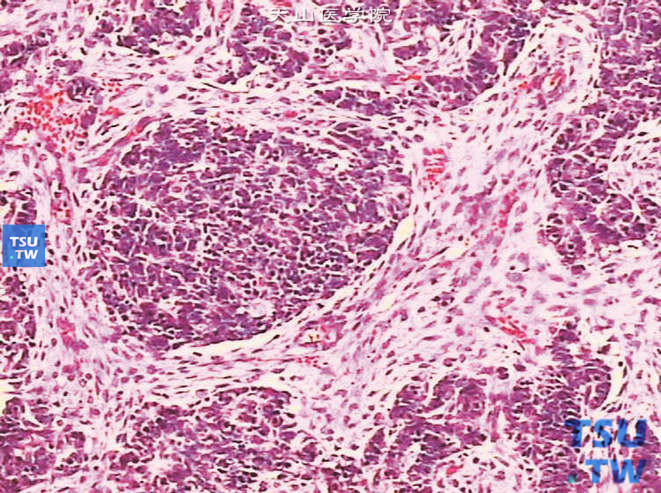儿童肾母细胞瘤，镜下显示巢状原始肾胚芽和间叶组织，胚芽中可见向小管分化的上皮成分