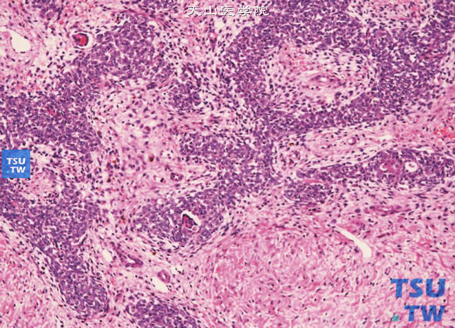 儿童肾母细胞瘤，上图放大后形态