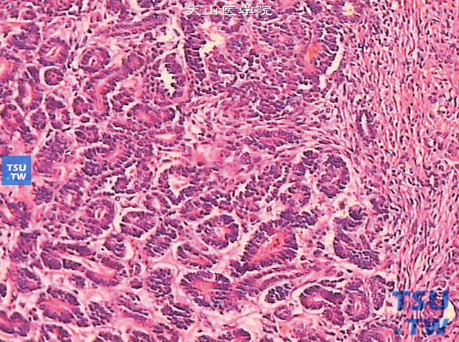 儿童肾母细胞瘤，镜下显示大量原始上皮和少量间叶组织