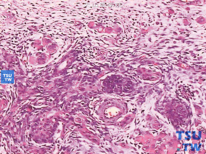 儿童肾母细胞瘤，镜下显示原始肾小球样及间叶组织