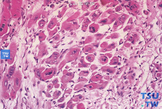 儿童肾母细胞瘤，镜下显示间叶组织，其中大多是肌母细胞