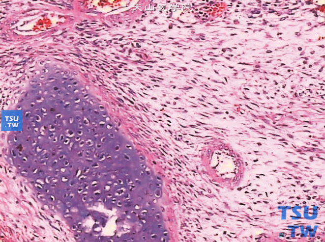 儿童肾母细胞瘤，镜下显示间叶组织，其中大多是肌母细胞
