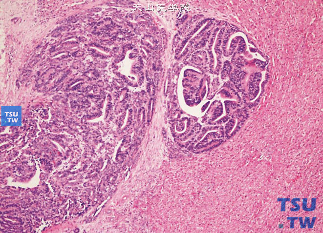 儿童肾母细胞瘤，镜下显示肝内转移灶，主要为原始上皮成分