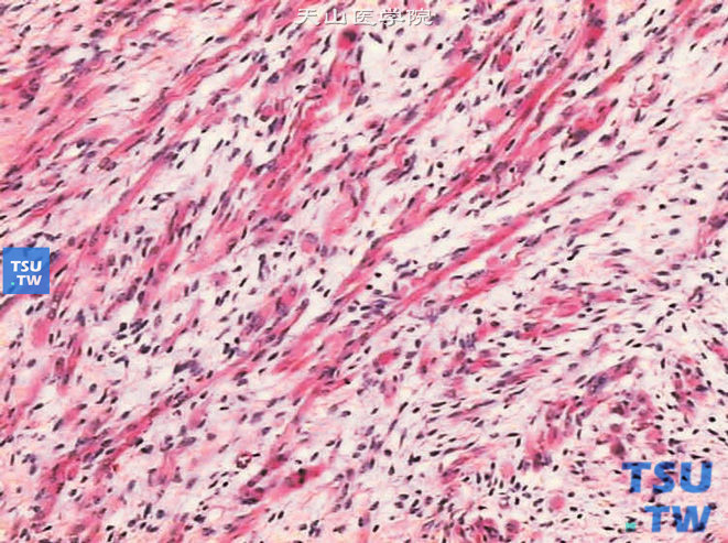儿童肾母细胞瘤，镜下显示大量长梭形胎儿横纹肌样为主的间叶组织