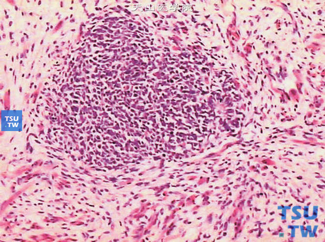 儿童肾母细胞瘤，镜下显示原始肾胚芽和间叶组织，病理诊断为胎儿横纹肌瘤型肾母细胞瘤