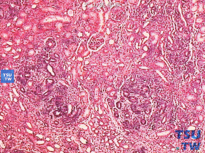 儿童肾母细胞瘤，镜下示髓质内多灶性未成熟原始小管和间叶组织（叶内型肾母细胞瘤病）