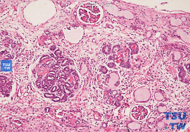 儿童肾母细胞瘤，镜下示肾实质内多灶性不成熟的原始小管和间叶成分（肾母细胞瘤病）