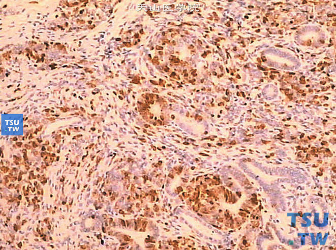 儿童肾母细胞瘤， 免疫组化，标记Ki-67后显示原始小管和间叶组织核染色阳性（40%细胞阳性）