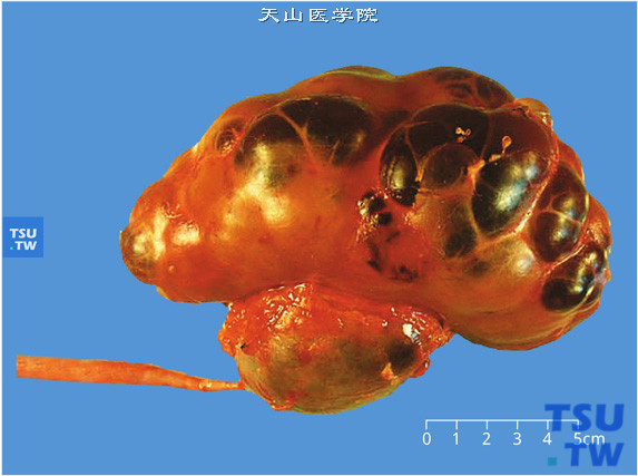儿童囊性肾瘤，囊壁薄，境界清楚，多房性（大体）