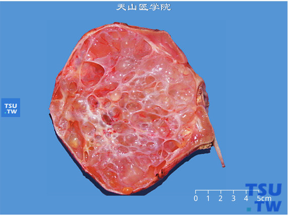 儿童囊性肾瘤，肾多囊性肿物，剖面呈蜂窝状、囊壁菲薄、未见实性肿物