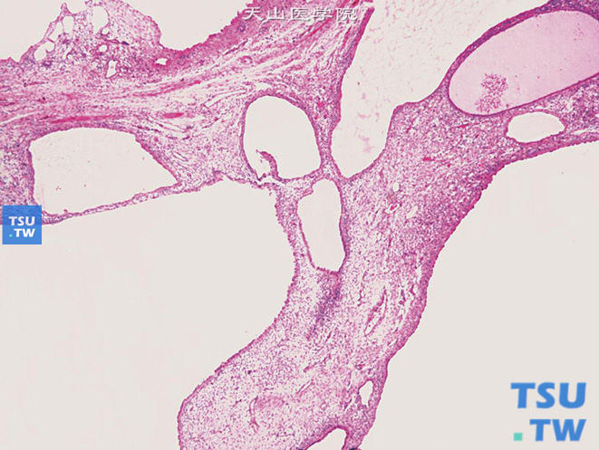 儿童囊性肾瘤，镜下显示多囊性、囊壁菲薄的肿物