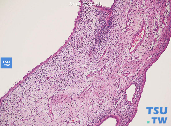 儿童囊性肾瘤，囊壁由纤维组织组成，未见原始肾胚芽