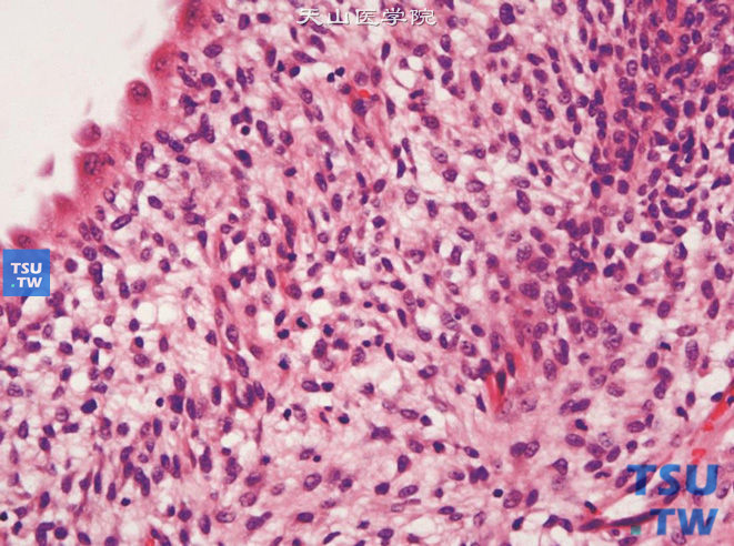 儿童囊性肾瘤，显示纤维组织组成的囊壁