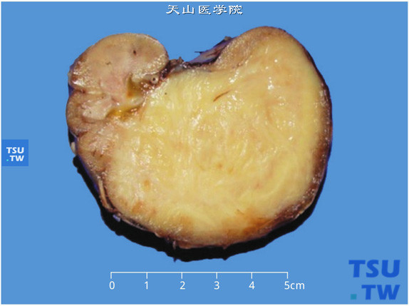 儿童先天性中胚叶肾瘤，剖面显示肾实性、质均、灰白色、肿物