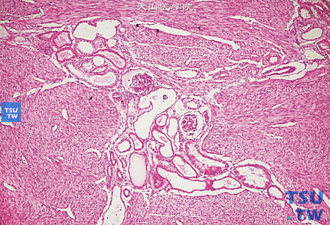 儿童先天性中胚叶肾瘤，镜下显示梭形细胞为主的肿瘤，期间混有肾小球和肾小管