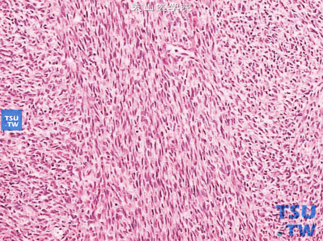 儿童先天性中胚叶肾瘤，镜下显示梭形细胞为主的肿瘤