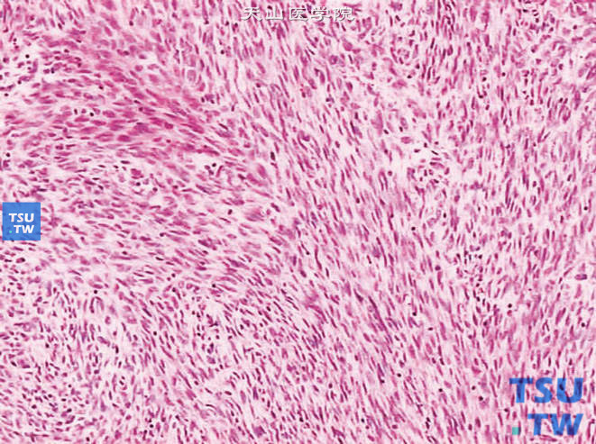 儿童先天性中胚叶肾瘤，镜下显示梭形细胞为主的肿瘤，像软组织纤维肉瘤