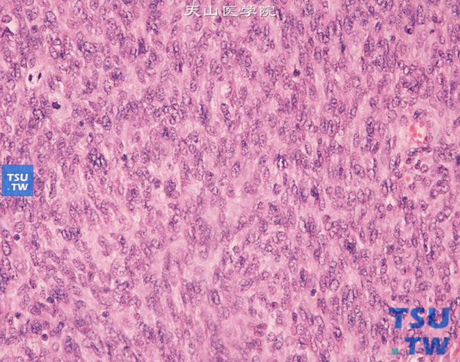 儿童先天性中胚叶肾瘤， 镜下示核分裂象易见