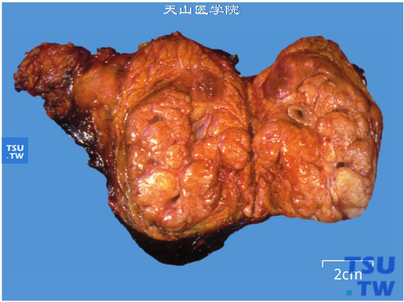 儿童肾透明细胞肉瘤，分叶状，色泽混杂（大体）