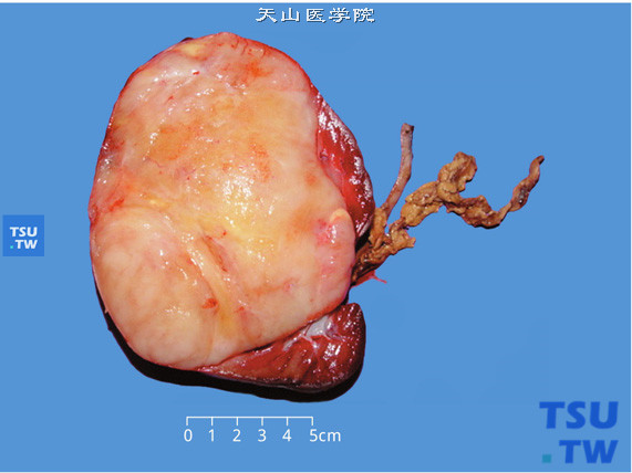 儿童肾透明细胞肉瘤，剖面显示肾一侧肿瘤、鱼肉状