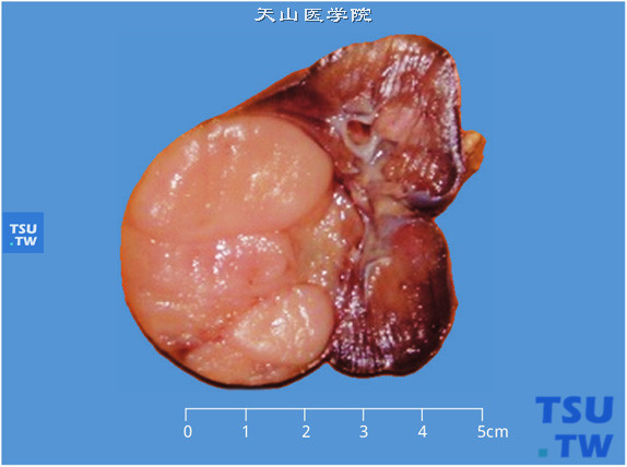 儿童肾透明细胞肉瘤，剖面显示肾一侧肿瘤、灰粉、质软、鱼肉状