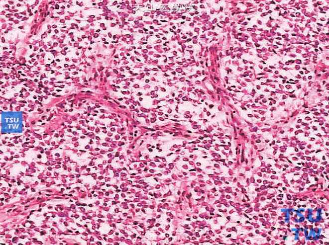 儿童肾透明细胞肉瘤，镜下显示肿瘤小圆瘤细胞、胞质浅染、部分透明、核呈空泡状、核仁不清，肿瘤间有树枝状纤维血管