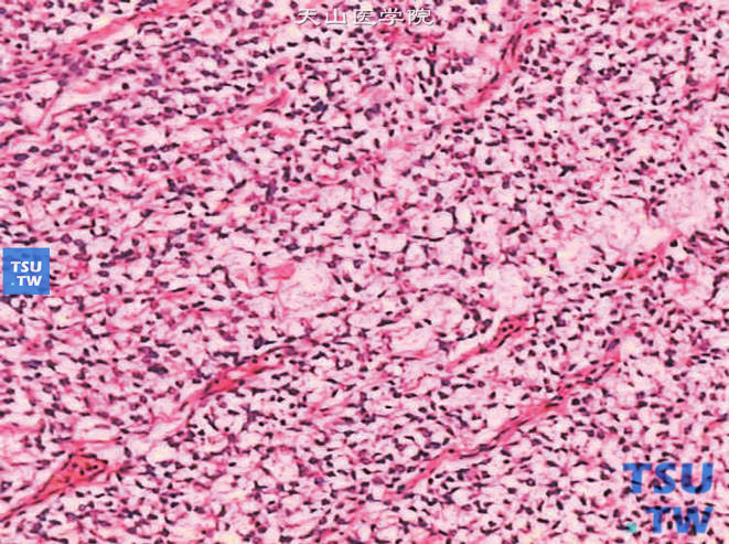 儿童肾透明细胞肉瘤，镜下显示肿瘤细胞间粉染黏液样物