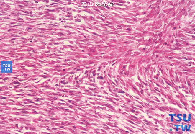 儿童肾透明细胞肉瘤，镜下显示梭形瘤细胞