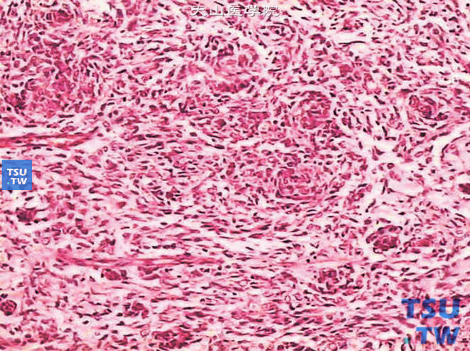 儿童肾透明细胞肉瘤，镜下显示瘤细胞呈上皮样排列