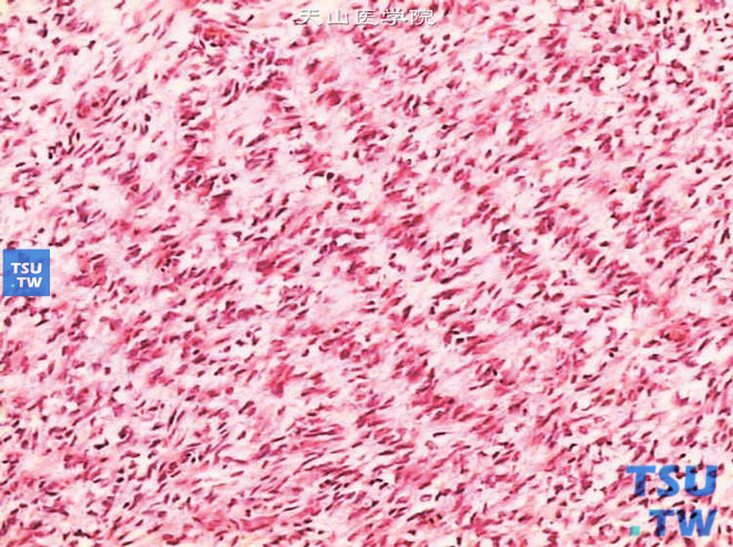 儿童肾透明细胞肉瘤，镜下显示瘤细胞呈栅栏状排列