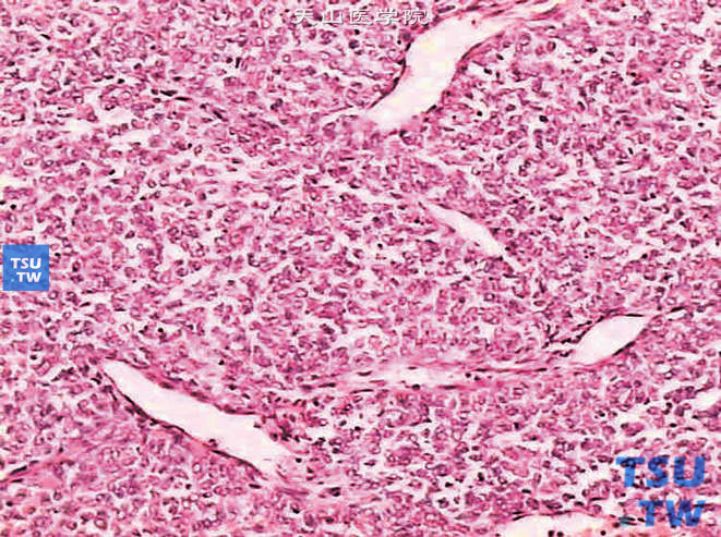 儿童肾透明细胞肉瘤，镜下显示瘤细胞呈血管周细胞样瘤排列
