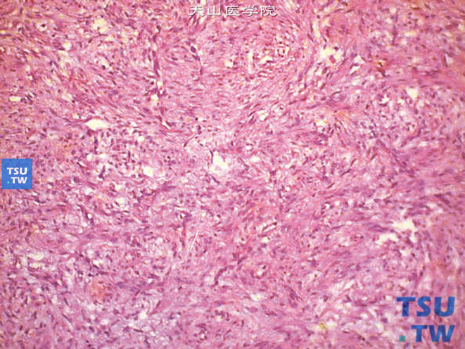 儿童肾透明细胞肉瘤，镜下显示瘤细胞呈轮辐状排列