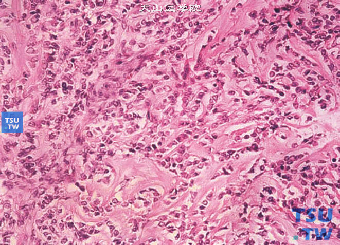 儿童肾透明细胞肉瘤，镜下显示瘤细胞间粉红色间质，形态像骨肉瘤
