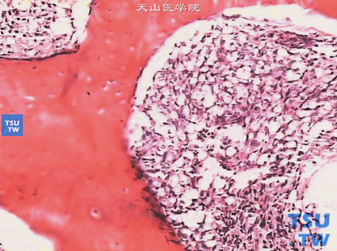 儿童肾透明细胞肉瘤，镜下显示骨髓中转移的肿瘤细胞