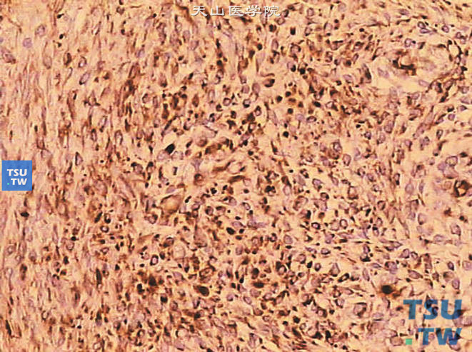 儿童肾透明细胞肉瘤，免疫组化显示瘤细胞Vimentin阳性