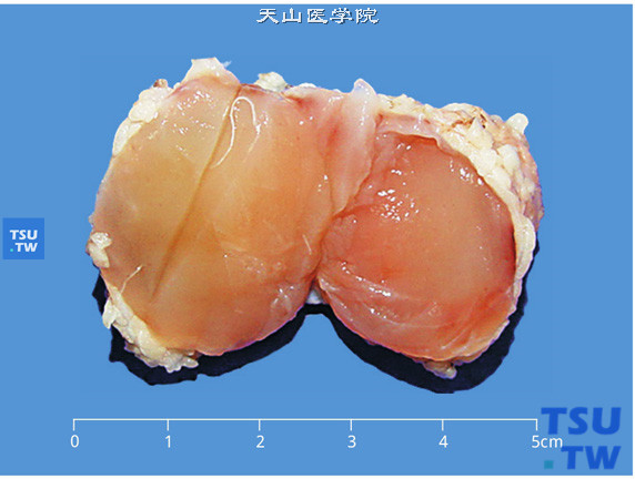 儿童肾透明细胞肉瘤，腿部转移，剖面显示灰粉、鱼肉状肿物