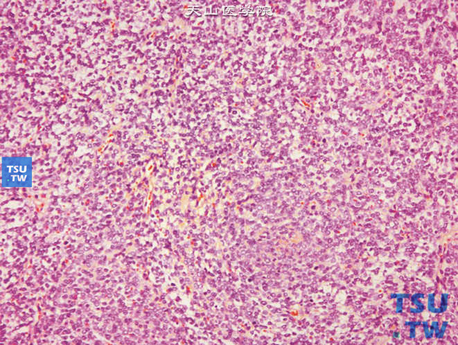 儿童肾透明细胞肉瘤，腿部转移，上图放大，镜下显示小圆细胞肿瘤