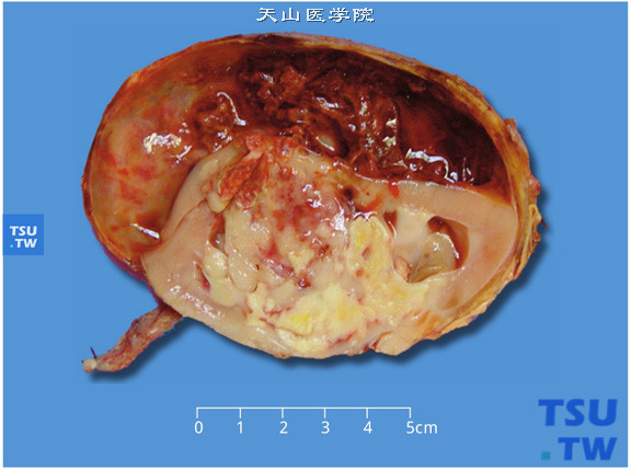 儿童肾恶性横纹肌样瘤，剖面显示肾肿瘤出血坏死、肿瘤沿肾实质内浸润