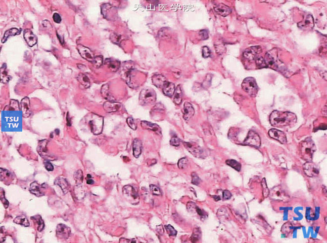 儿童肾恶性横纹肌样瘤，镜下显示瘤细胞大核仁、胞质粉染丰富，并见胞质包涵体